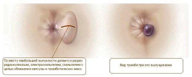 Тромбоз геморроидального узла (тромбофлебит) - лечение в СПб